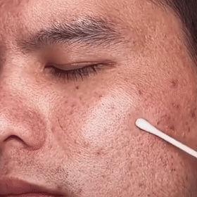 Oryon|¡Elimina puntos negros e impurezas en sólo 10 minutos!