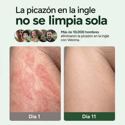 Los hombres que se deshicieron de años de tiña inguinal para siempre no usarán ningún otro producto.