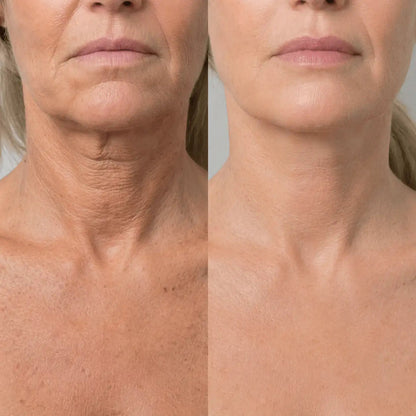 Rellena sin agujas. Sin clínica. K-Glow® · 1+1 GRATIS
